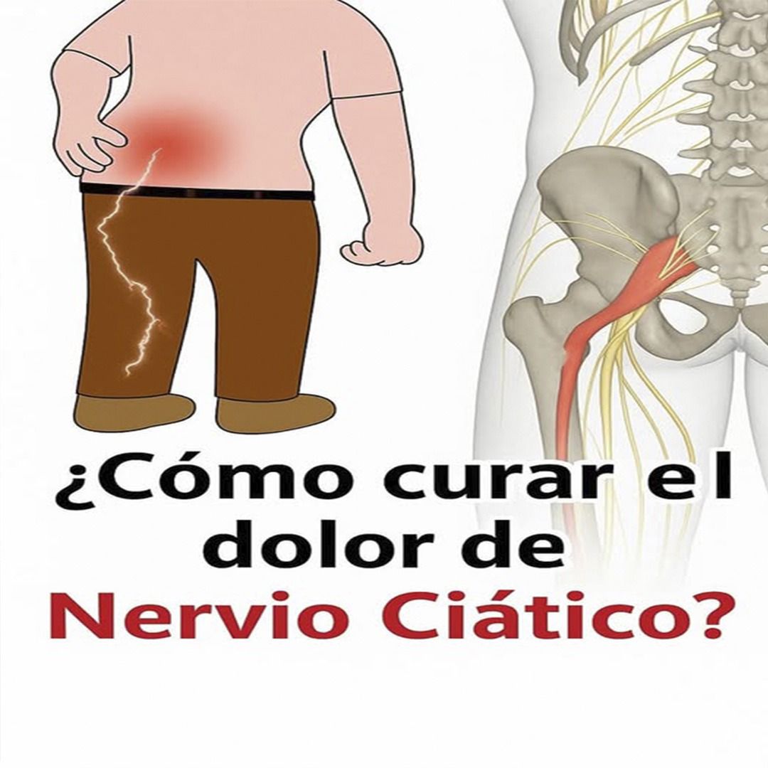 Diagrama del Nervio Ciático