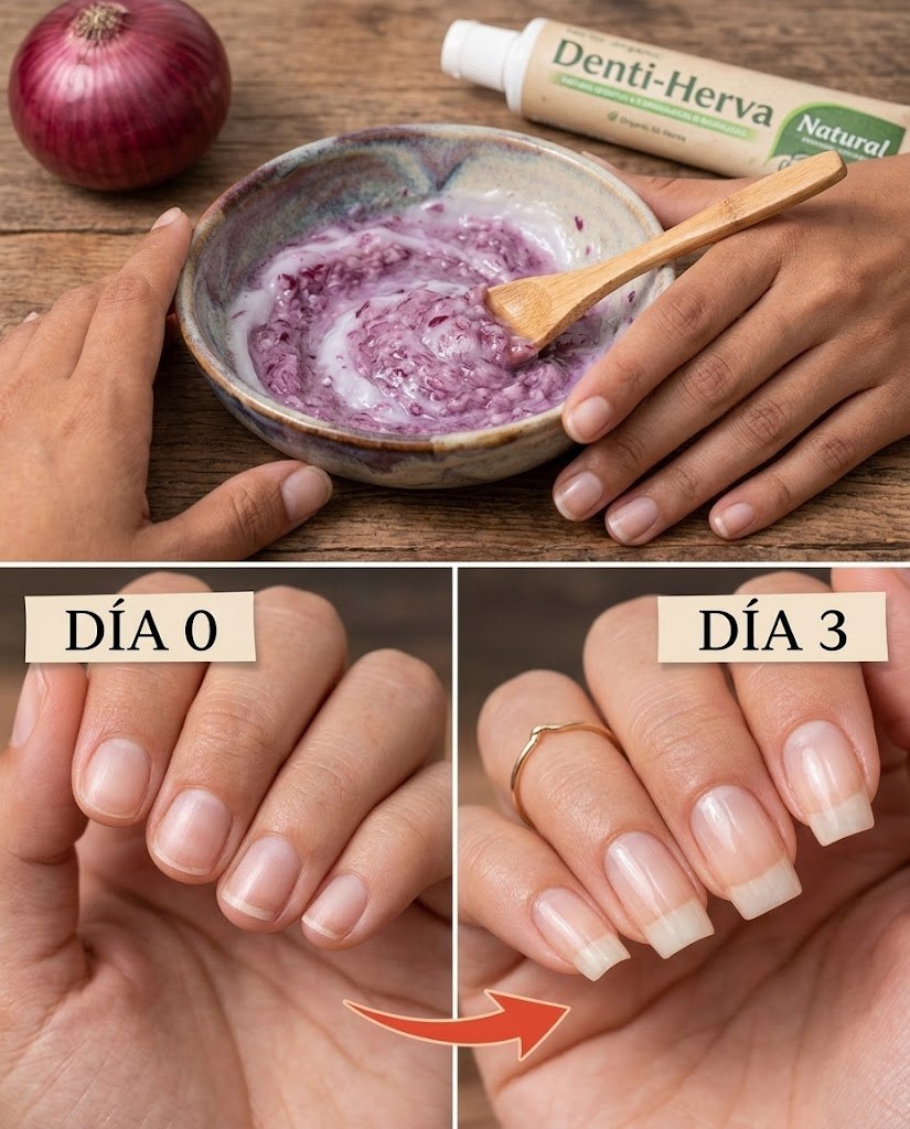 Remedio casero para el crecimiento de uñas con cebolla