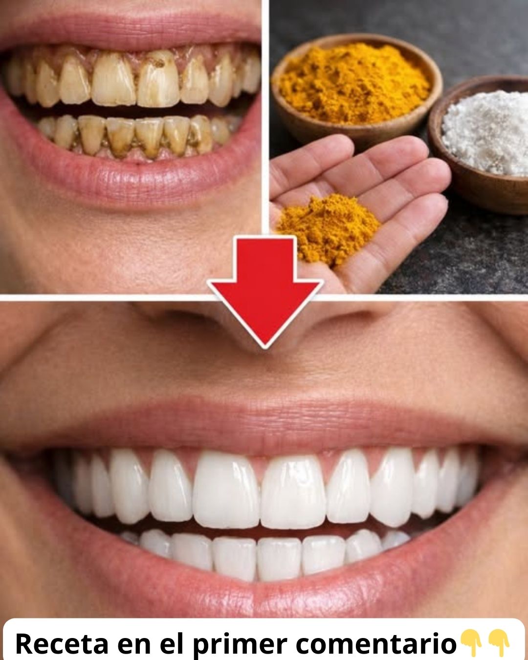 Antes y después del blanqueamiento de dientes con cúrcuma y bicarbonato
