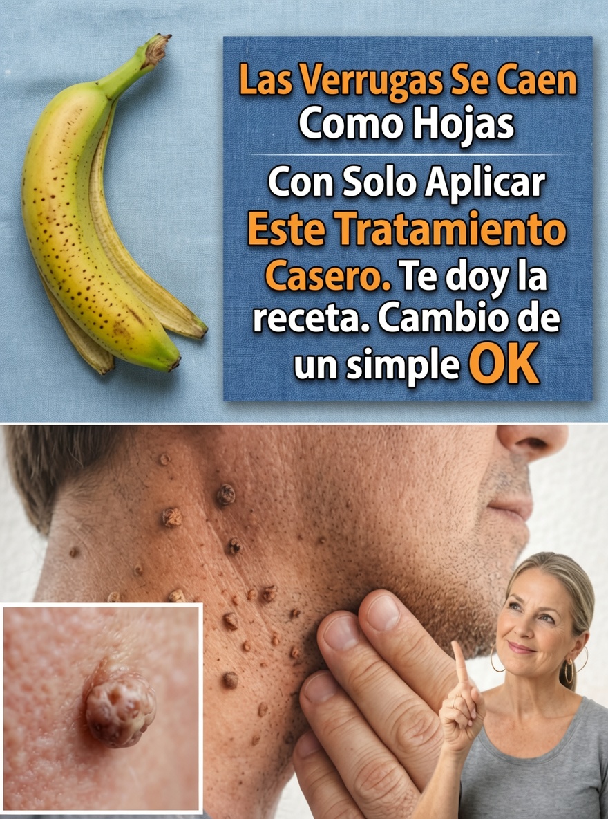 Tratamientos Caseros para Eliminar Verrugas