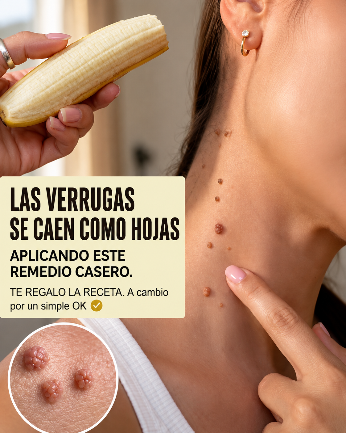Cáscara de plátano como remedio para verrugas